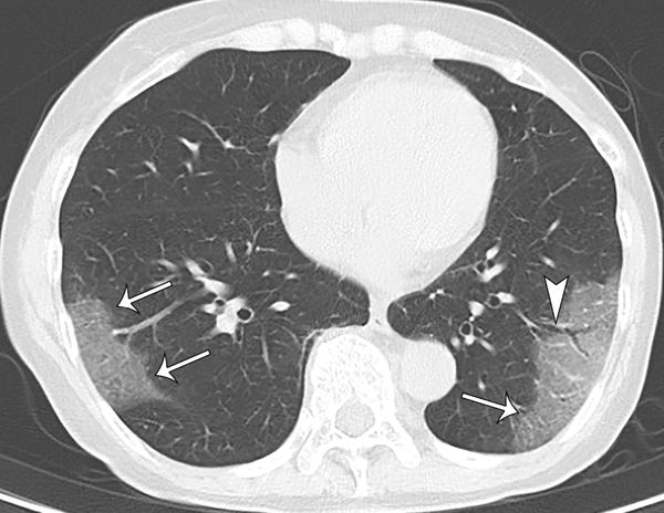 Chest CT Findings in COVID-19